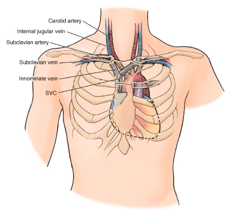 Anterior chest illustration showing carotid artery, internal jugular vein, subclavian artery and vein, innominate vein, and SVC with catheter coursing toward the right atrium