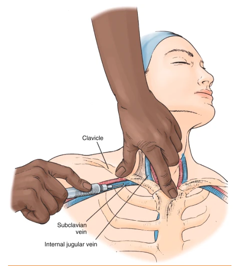 Operator hand positioning for right IJ access — non-dominant index and middle fingers palpating carotid pulse medial to the needle entry point