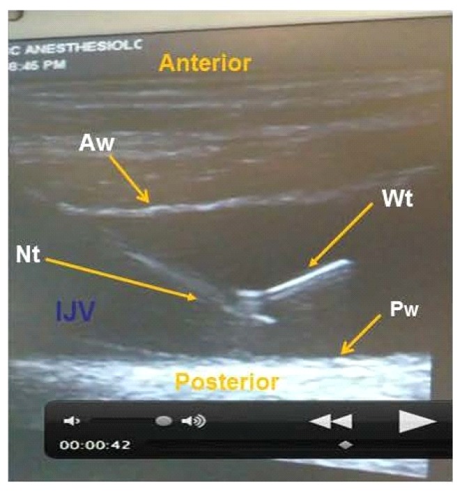 Long-axis ultrasound showing the echogenic guidewire emerging from the needle tip and curving into the internal jugular vein lumen