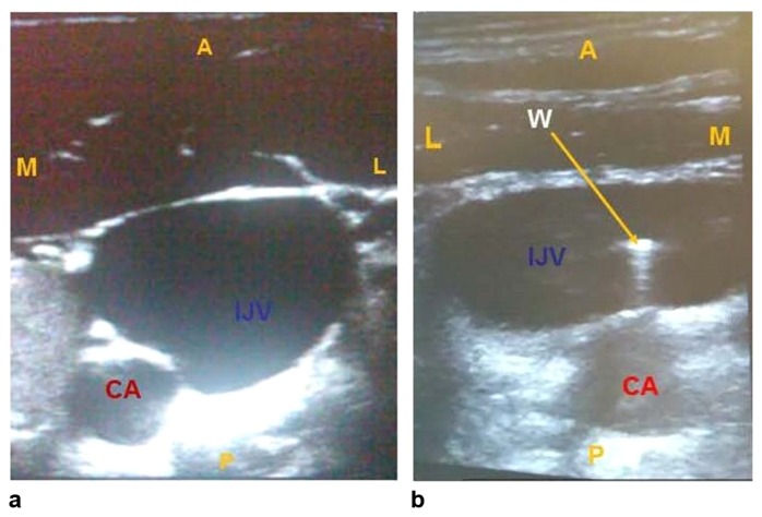 Short-axis ultrasound at right IJ showing the round compressible internal jugular vein adjacent to the pulsatile carotid artery