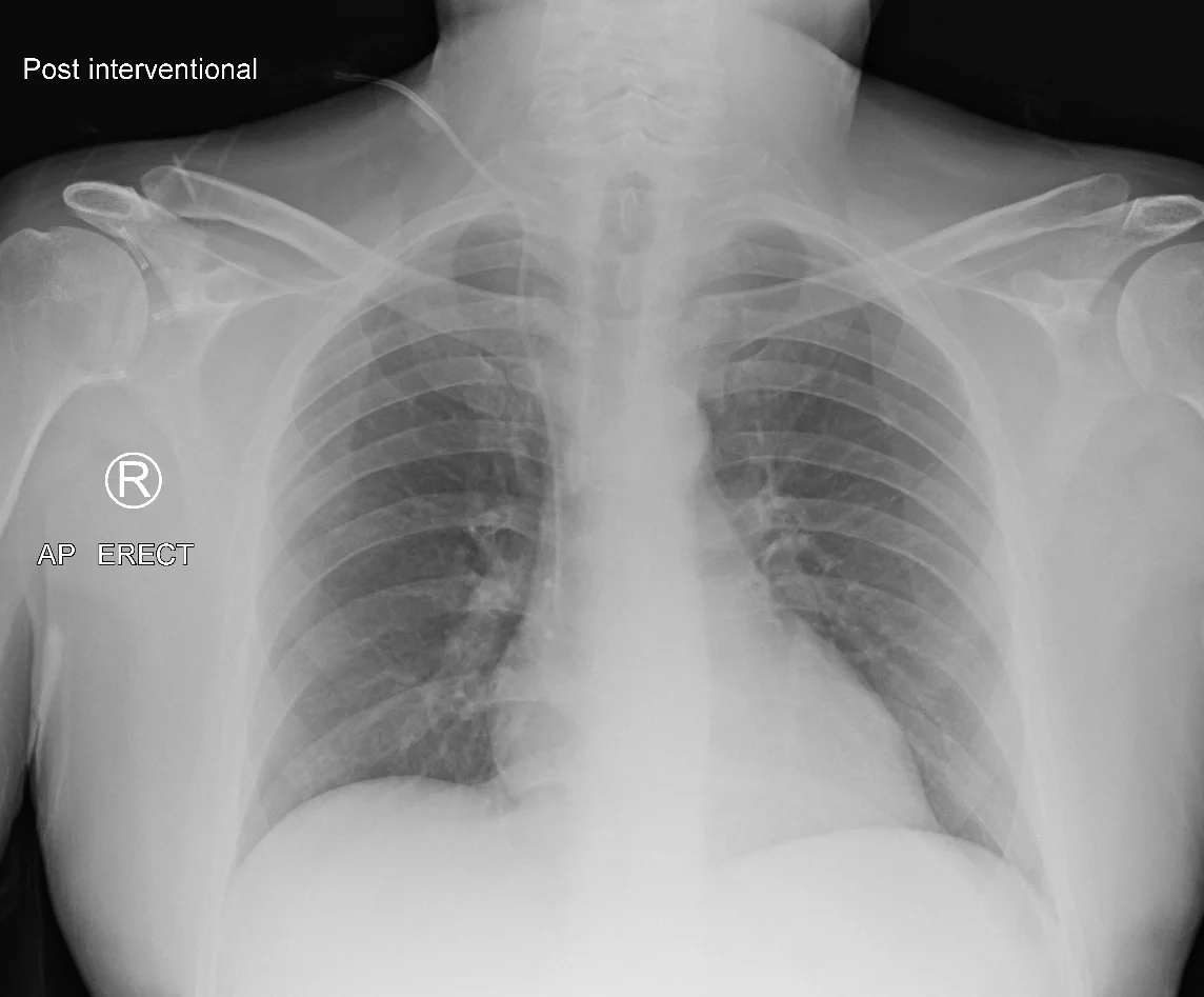 Upright PA chest radiograph showing a right internal jugular central venous catheter with the tip at the cavo-atrial junction — the textbook correct-tip exemplar