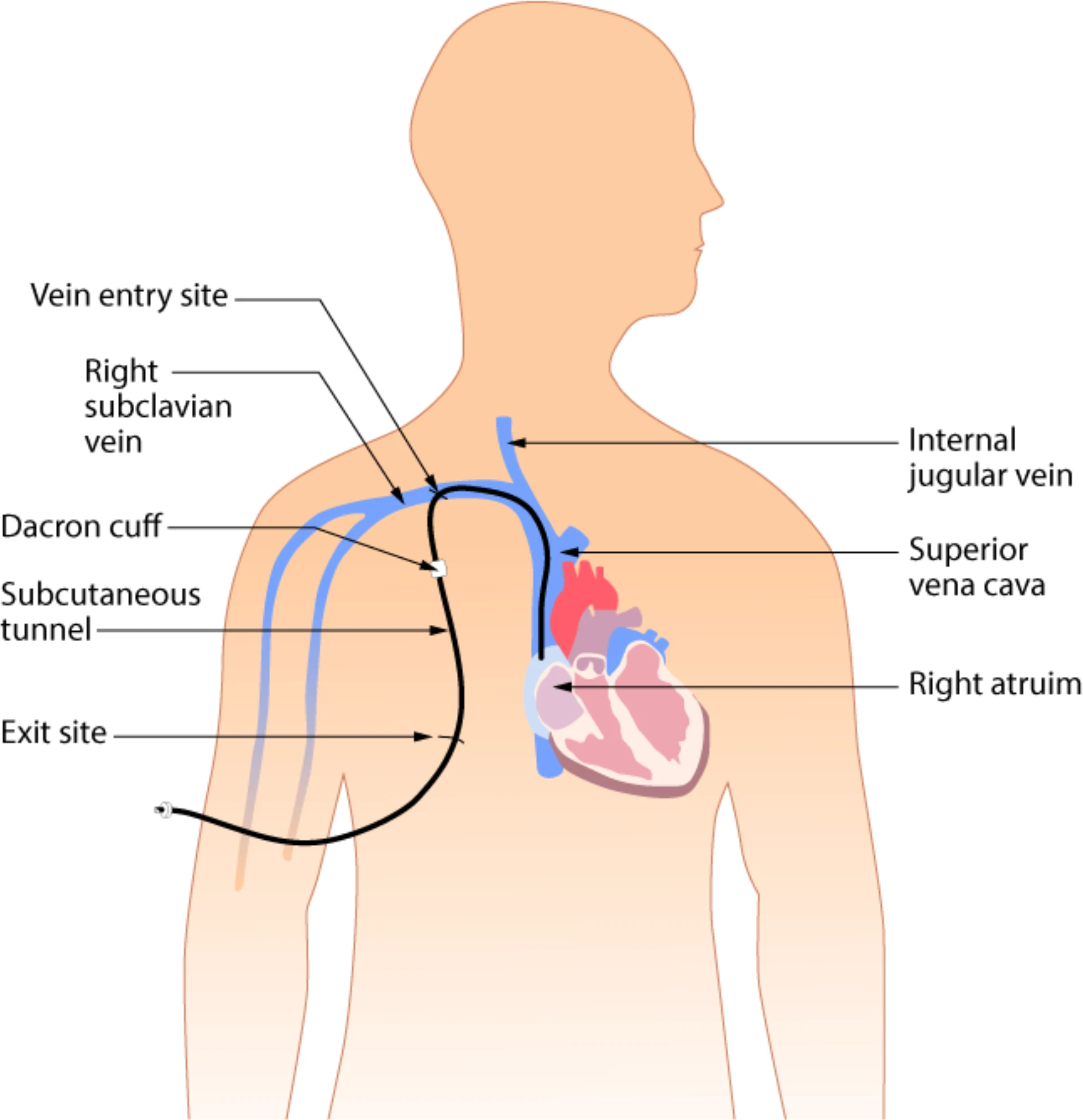 Central venous access device — chest-wall exit site, subcutaneous tunnel, catheter entry into central vein