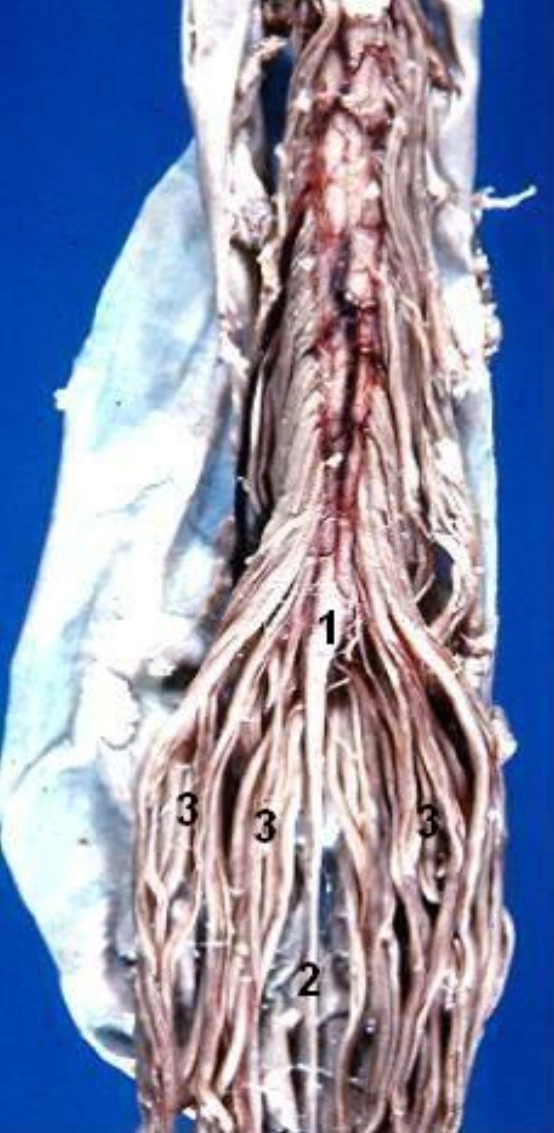 Anterior dissection of the human caudal spinal cord showing conus medullaris terminating around L1-L2 with the cauda equina nerve roots descending through the lumbar cistern