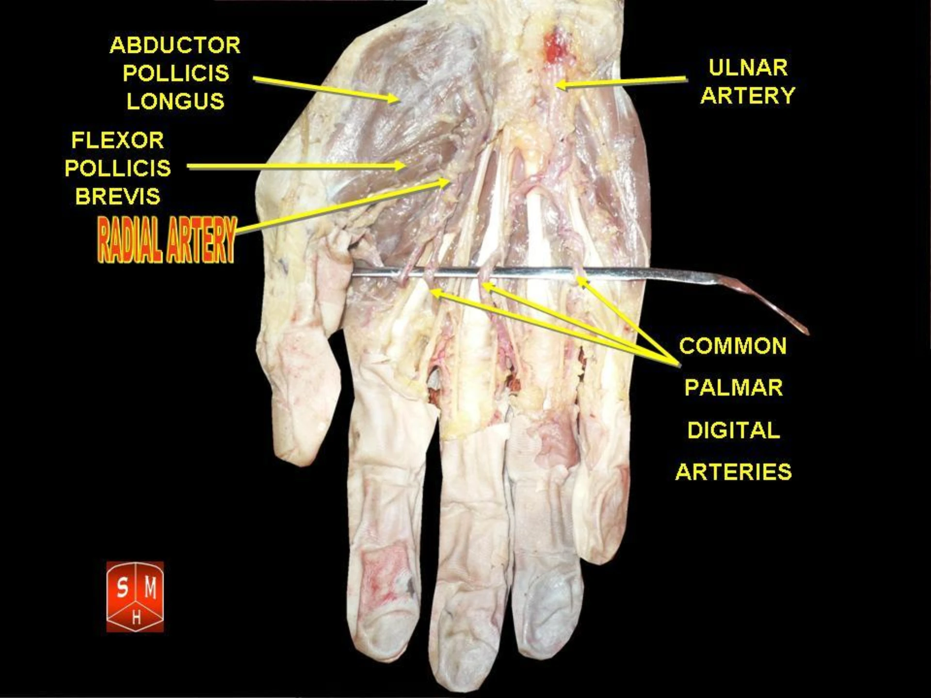 Cadaveric dissection at the distal forearm showing the radial artery and its relationship to surrounding structures at the planned cannulation depth