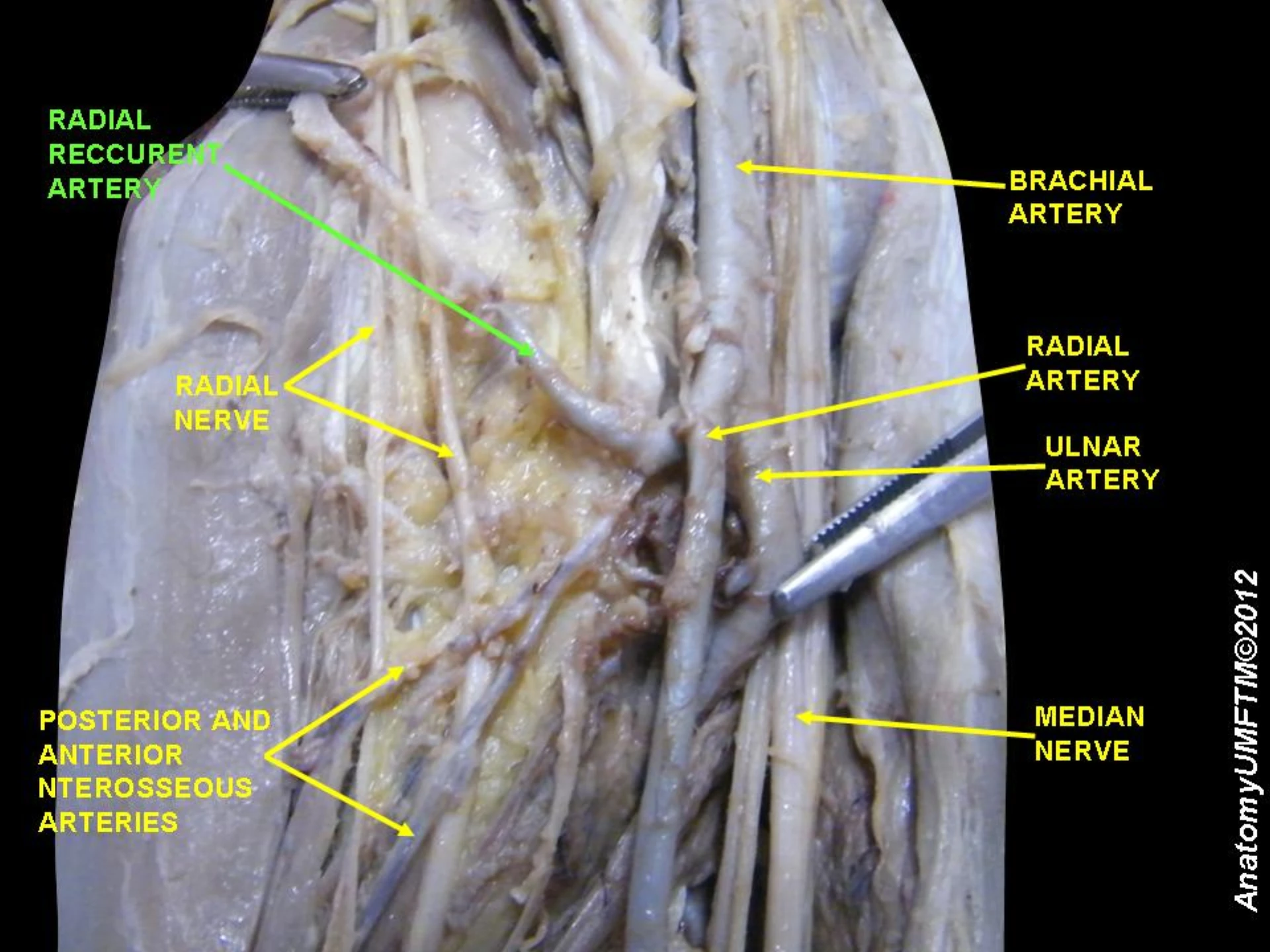 Cadaveric close-up at the wrist showing the radial artery cannulation target between the flexor carpi radialis tendon and the radius