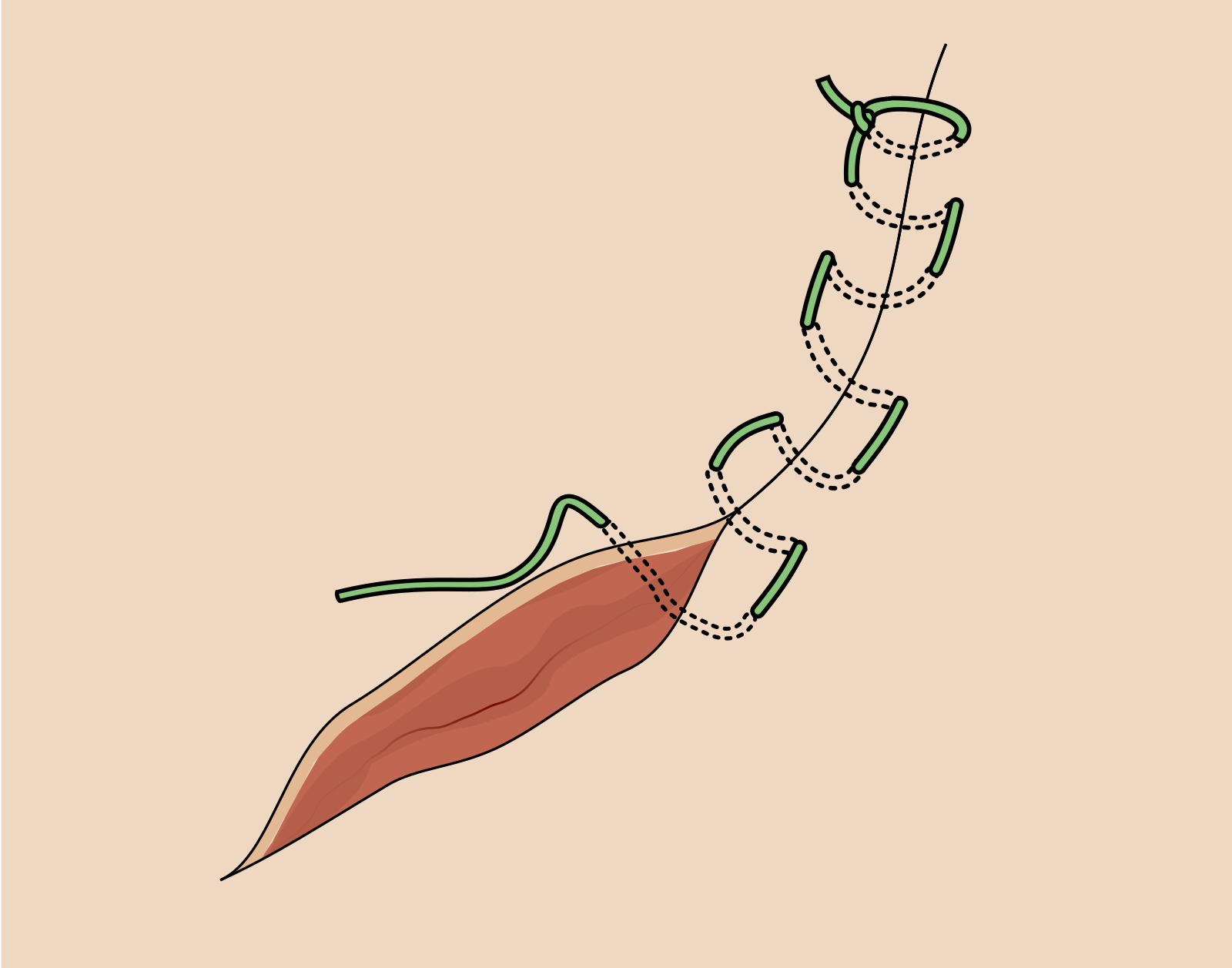 Continuous suture pattern diagram showing repeating loops across wound