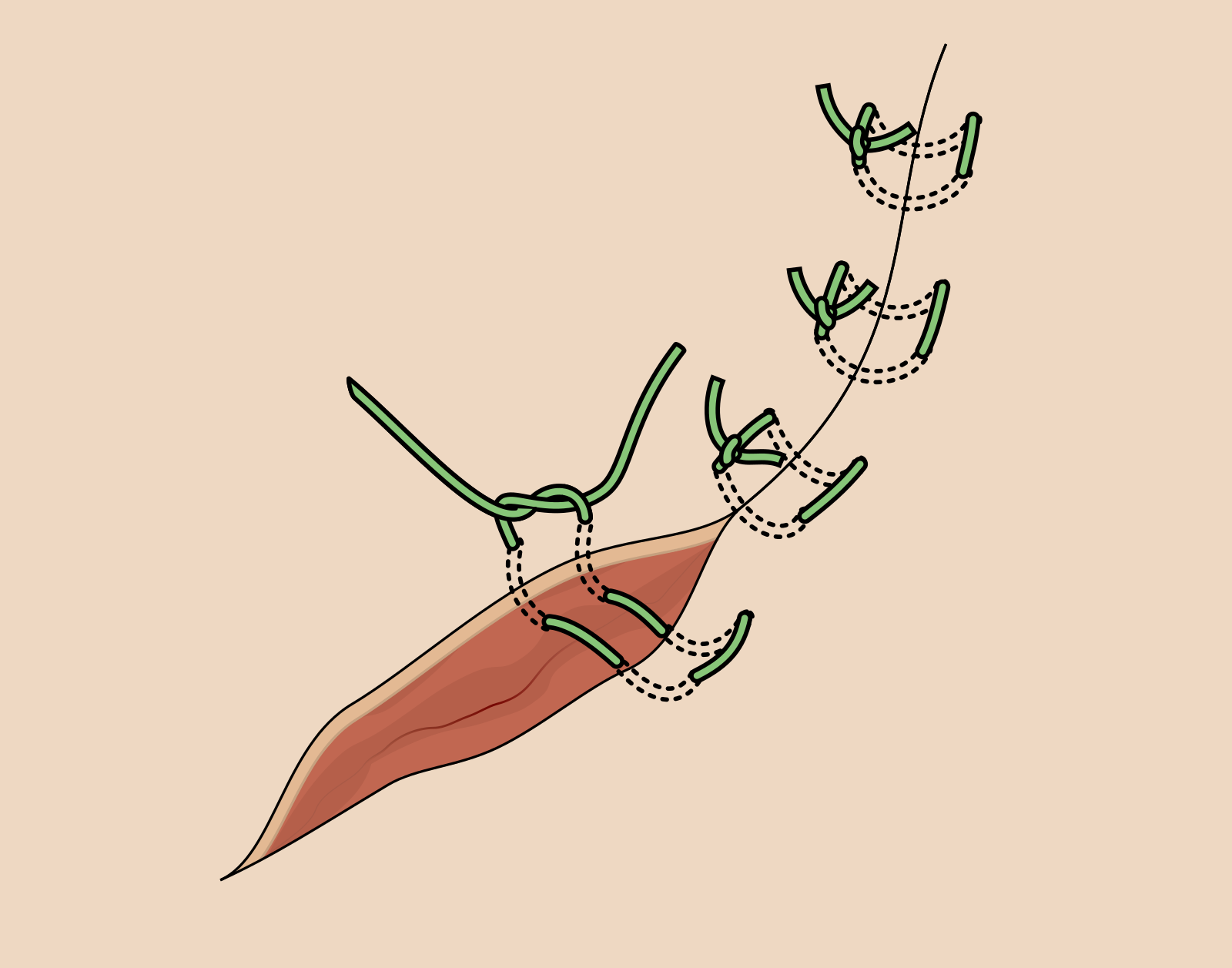 Horizontal mattress suture schematic — across the wound then back parallel