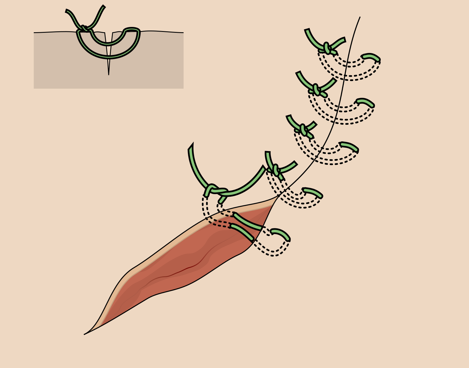 Vertical mattress suture schematic — far-far near-near pattern on same side