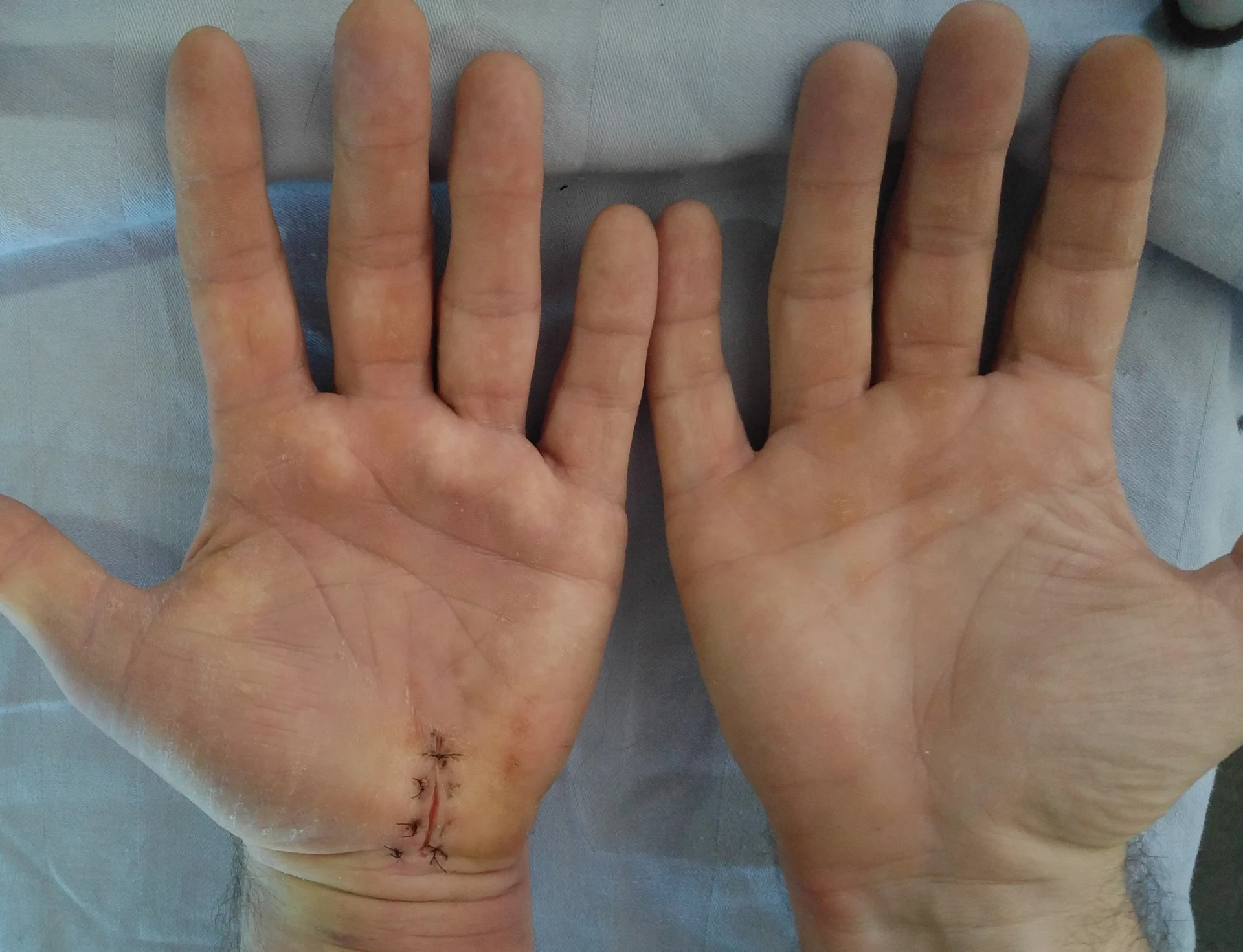 Photograph of a sutured surgical wound at day 3 post-closure showing apposed edges with no separation or purulence