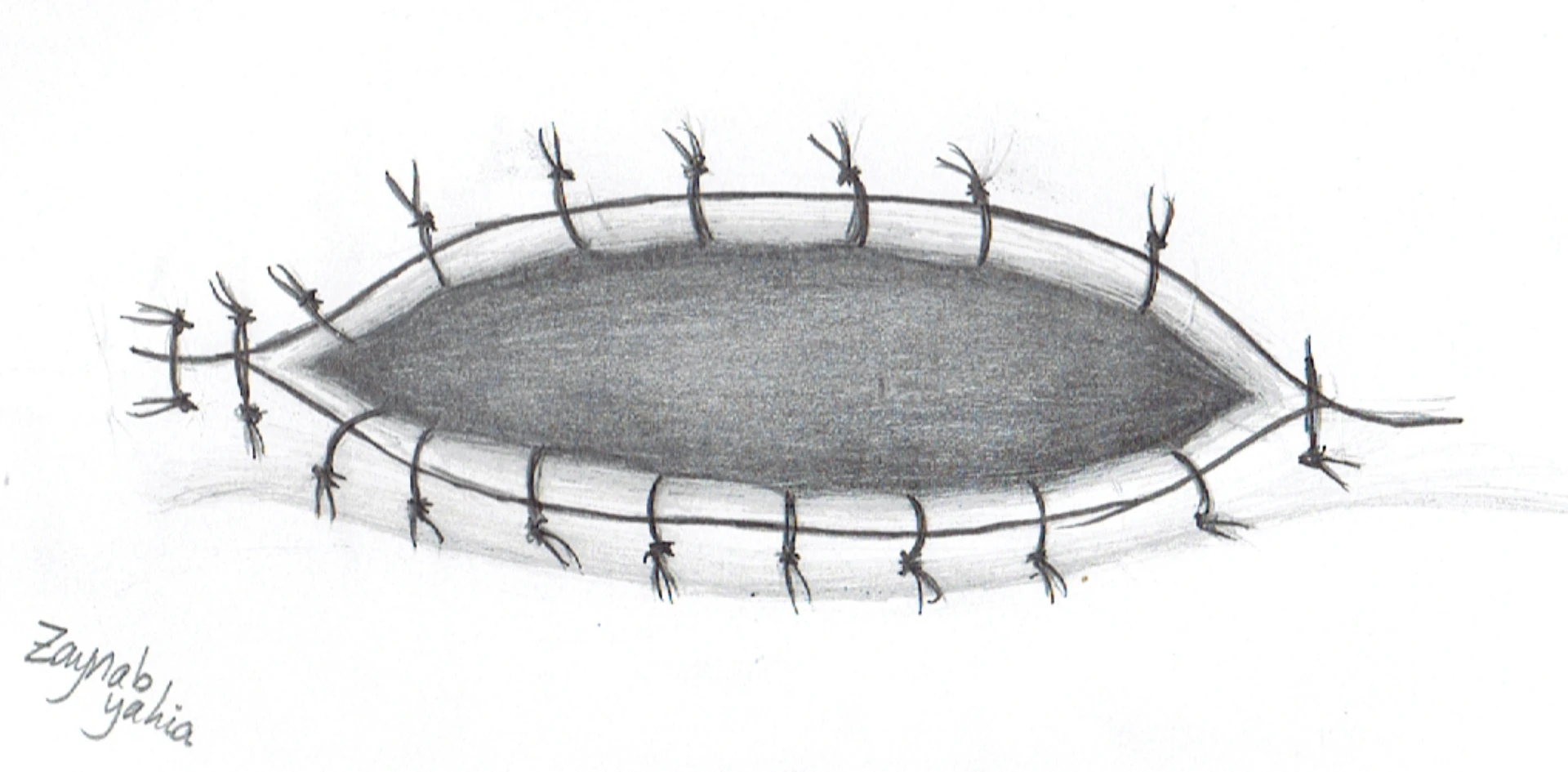 Wound supported by perpendicular interrupted closure — analog for the perpendicular-support geometry of Steri-Strip reinforcement