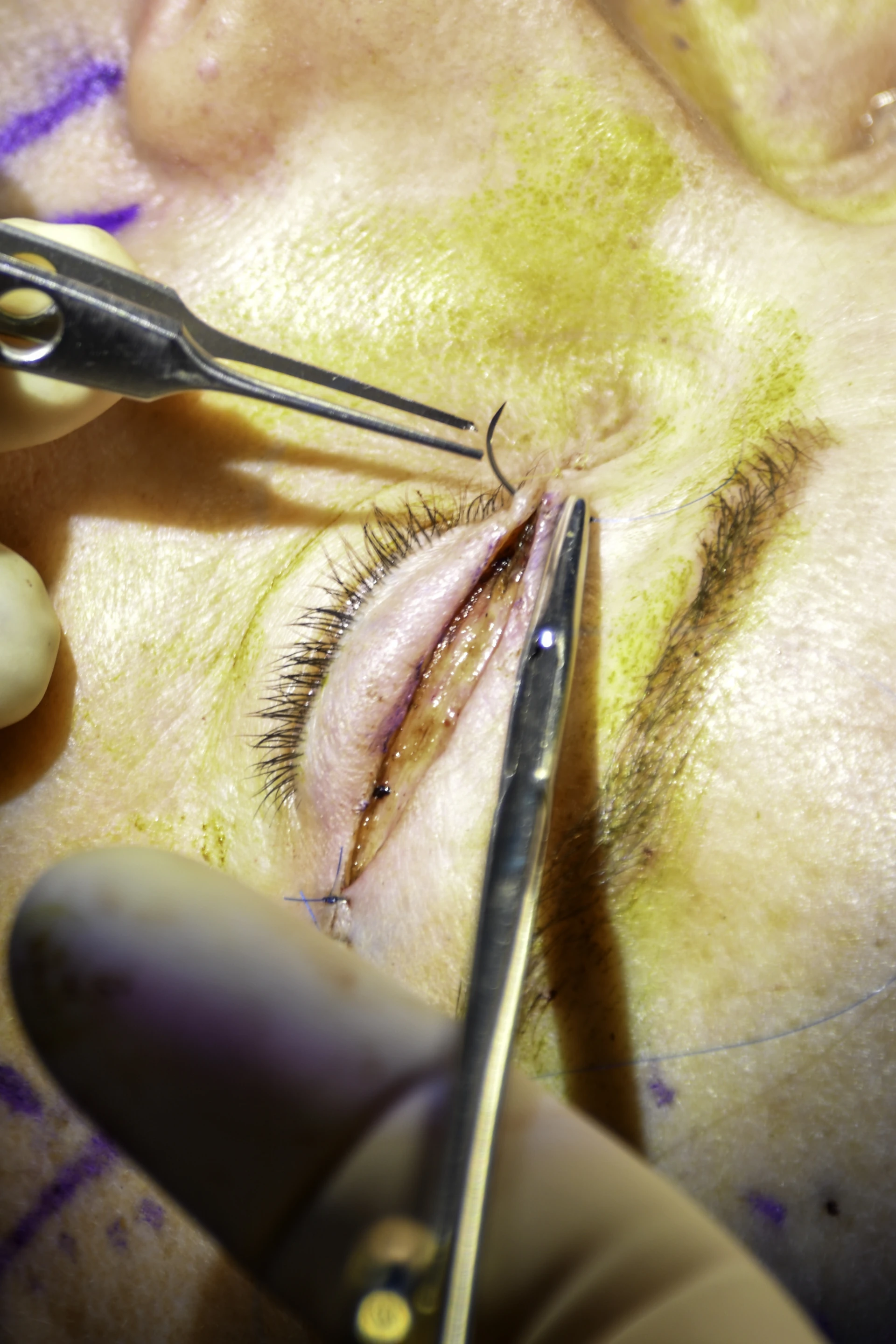 Mid-procedure suturing view with forceps and knot tension geometry — anatomic analog for the lift-knot, cut-below-knot, pull-through-side technique