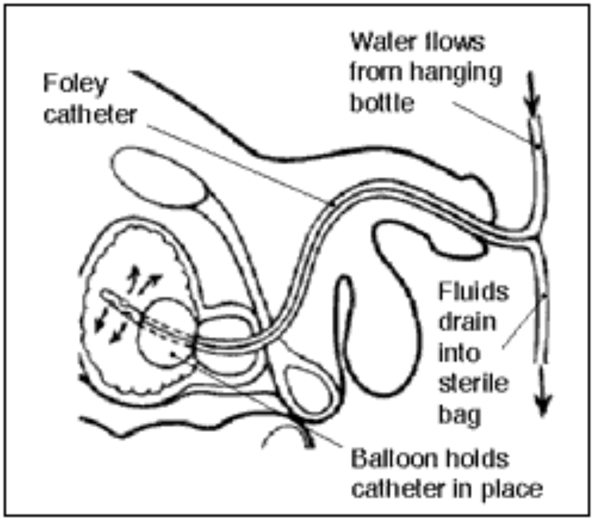 Cross-sectional schematic of indwelling urinary catheter seated in the bladder with inflated retention balloon at the bladder neck