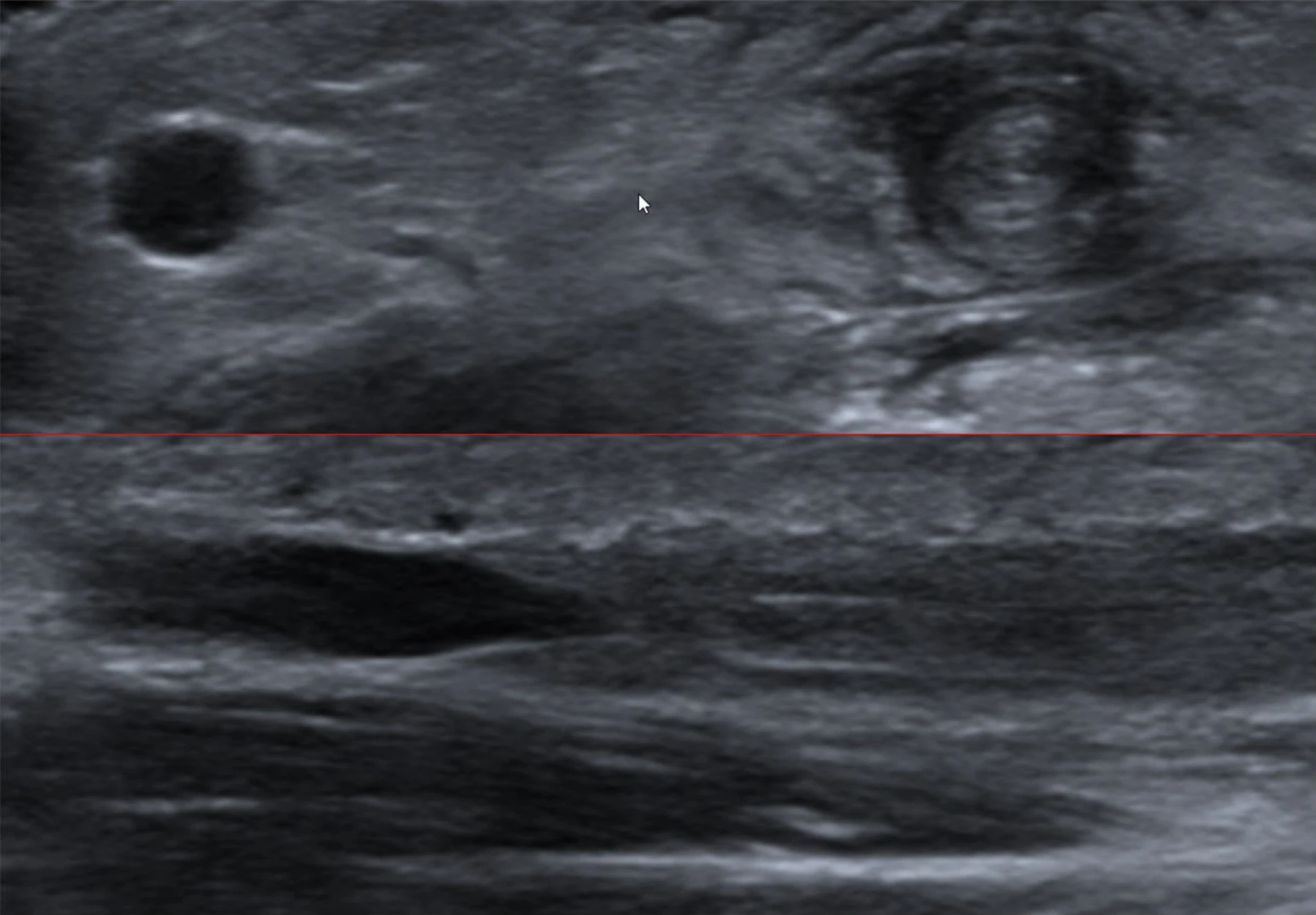 Ultrasound short-axis view of antecubital fossa veins — caliber and patency assessment more reliable than surface inspection
