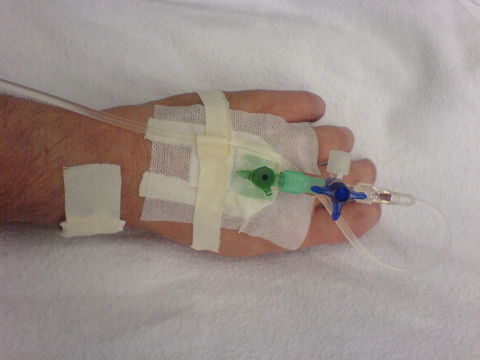Secured peripheral IV in a hand vein with two-port hub and transparent occlusive dressing — strain-relief loop visible