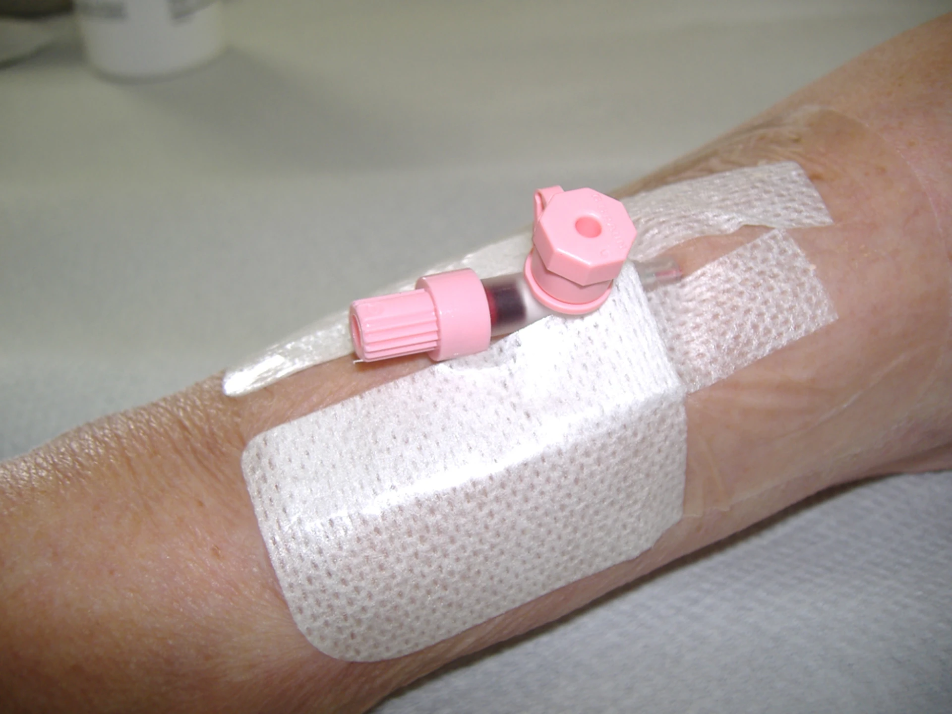 Bevel-up peripheral cannulation with non-dominant thumb providing skin traction distal to the puncture site