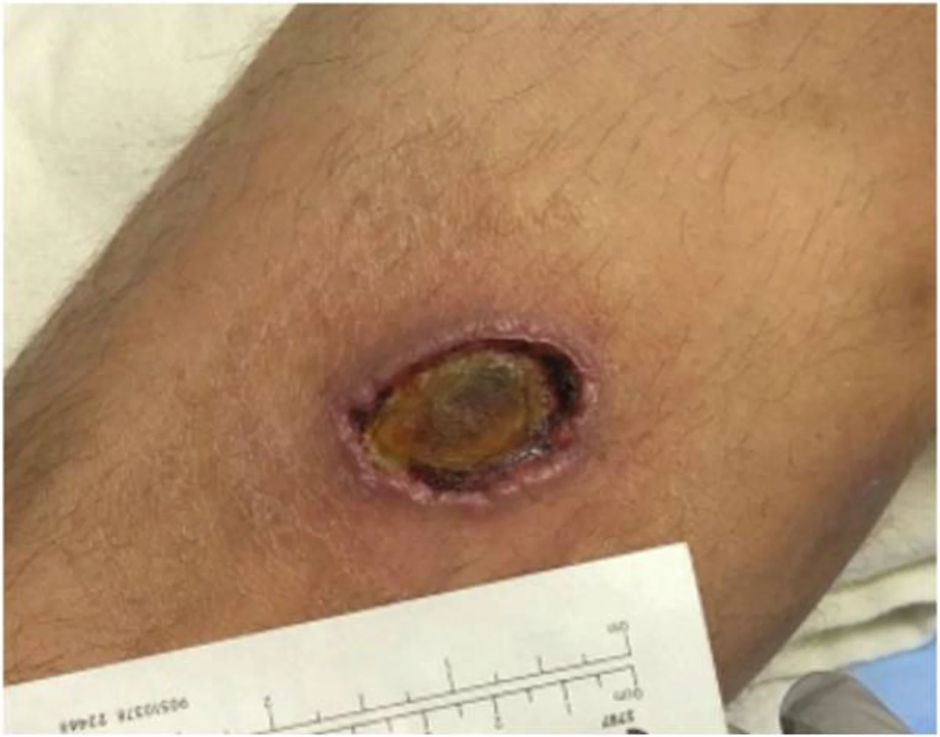 Clinical photograph of a necrotic ulcerative skin lesion of the type that prompts diagnostic punch biopsy