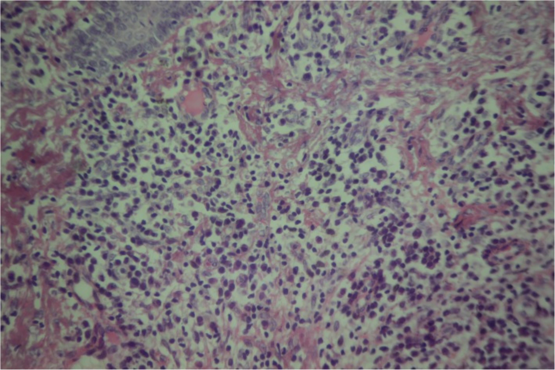 Hematoxylin and eosin photomicrograph of skin showing a moderately dense dermal infiltrate of plasma cells — example of downstream dermatopathology read from punch specimen