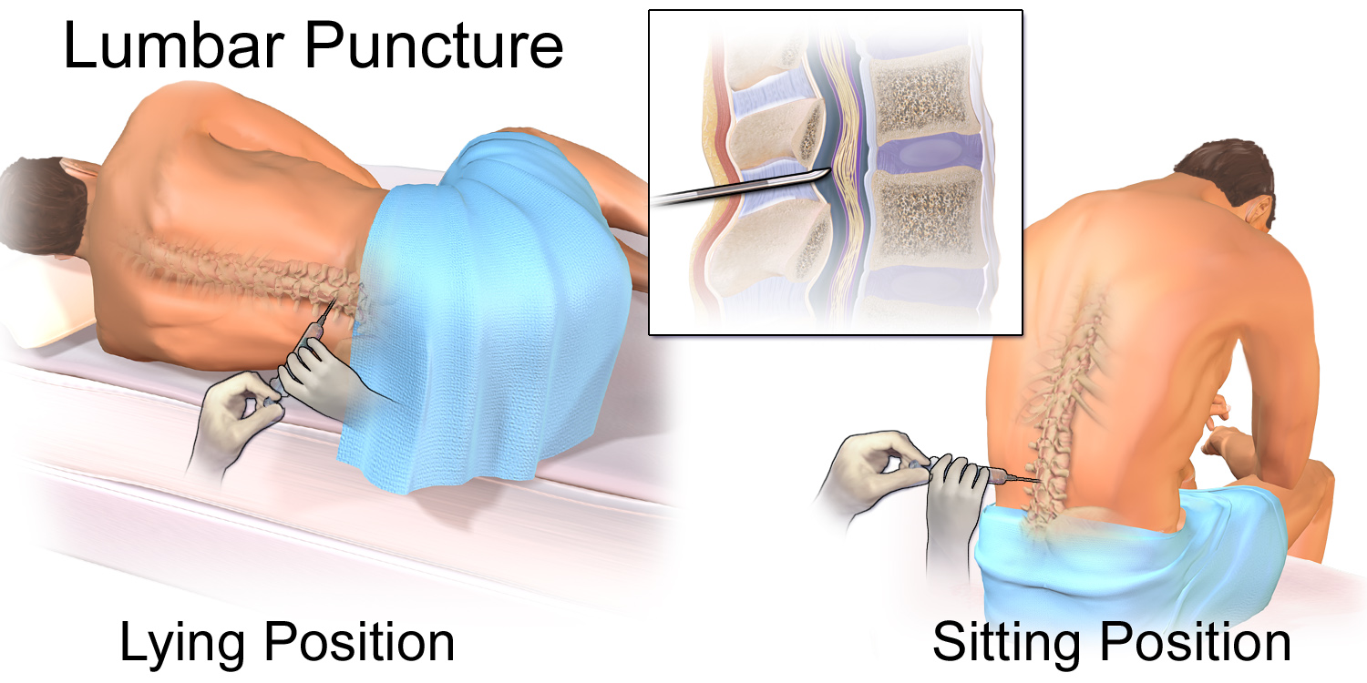 Sagittal lumbar spine showing needle entry at L3-L4 below conus medullaris, dural sac, and cauda equina floating in CSF