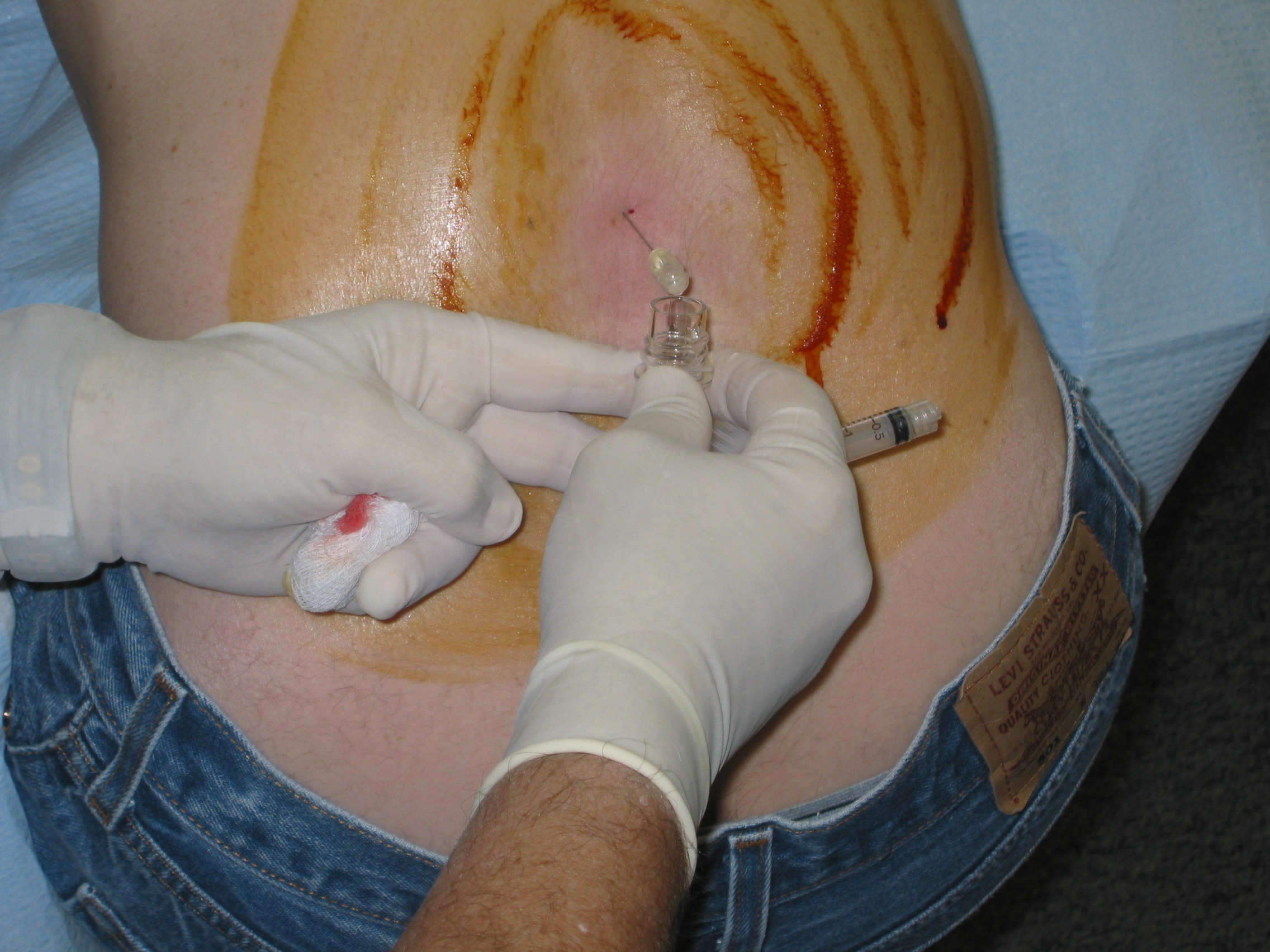 Patient seated for LP with iodine-prepped lumbar back and spinal needle in place