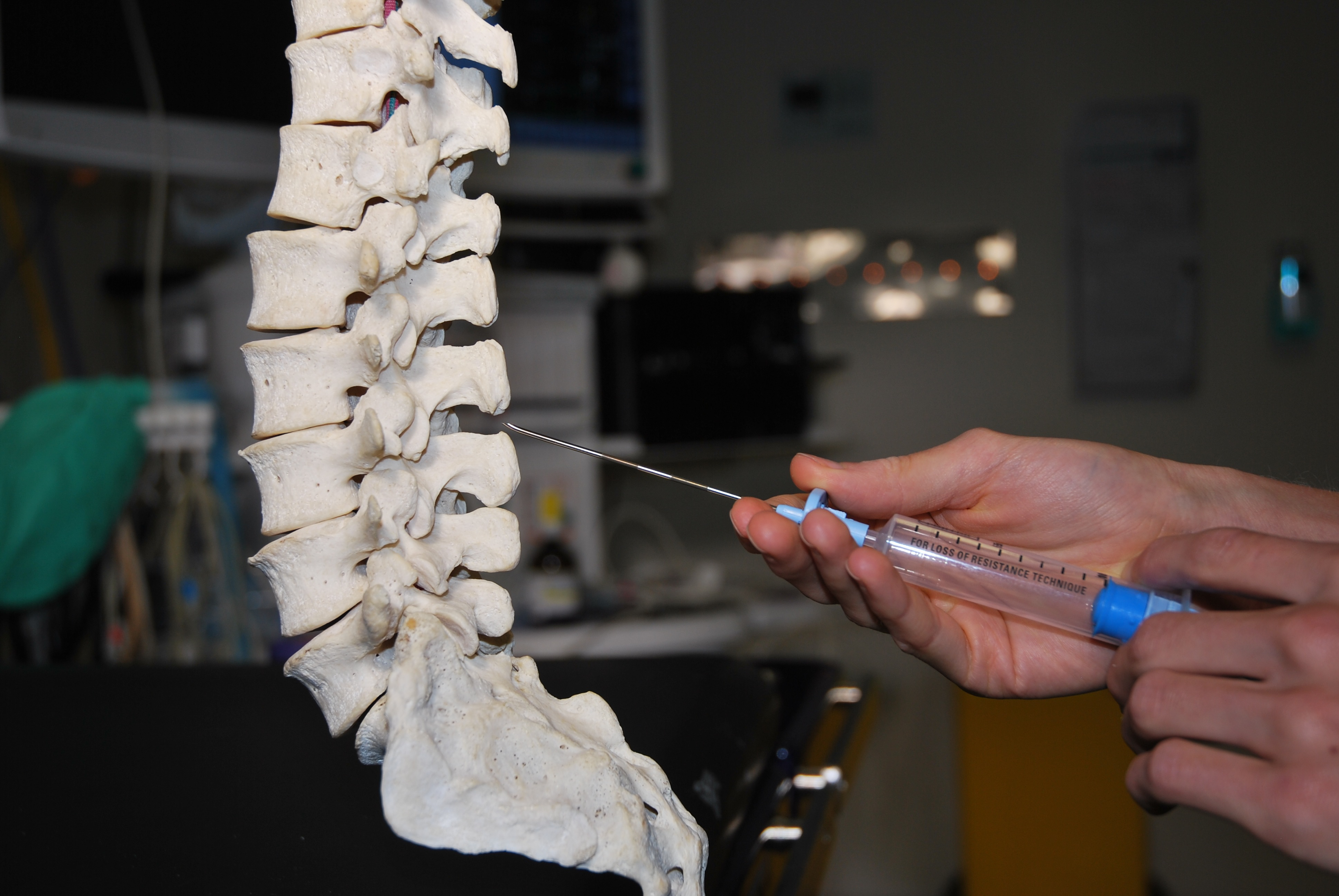 Needle inserted between lumbar spinous processes — simulation photograph