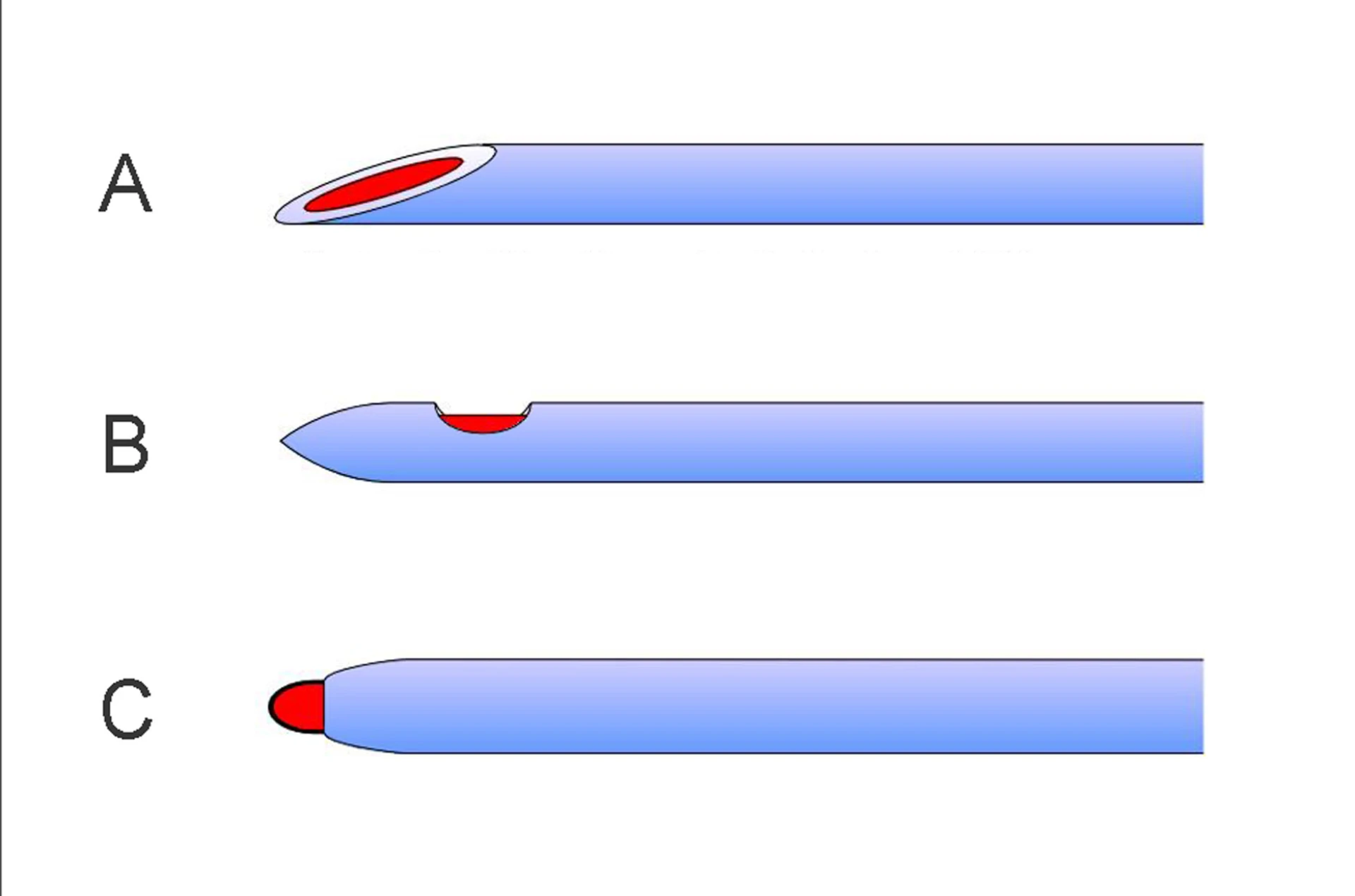 Three spinal-needle tip geometries — A: Quincke cutting bevel; B: pencil-point with side port (Sprotte); C: rounded ball-point — for tray selection on the kit checklist