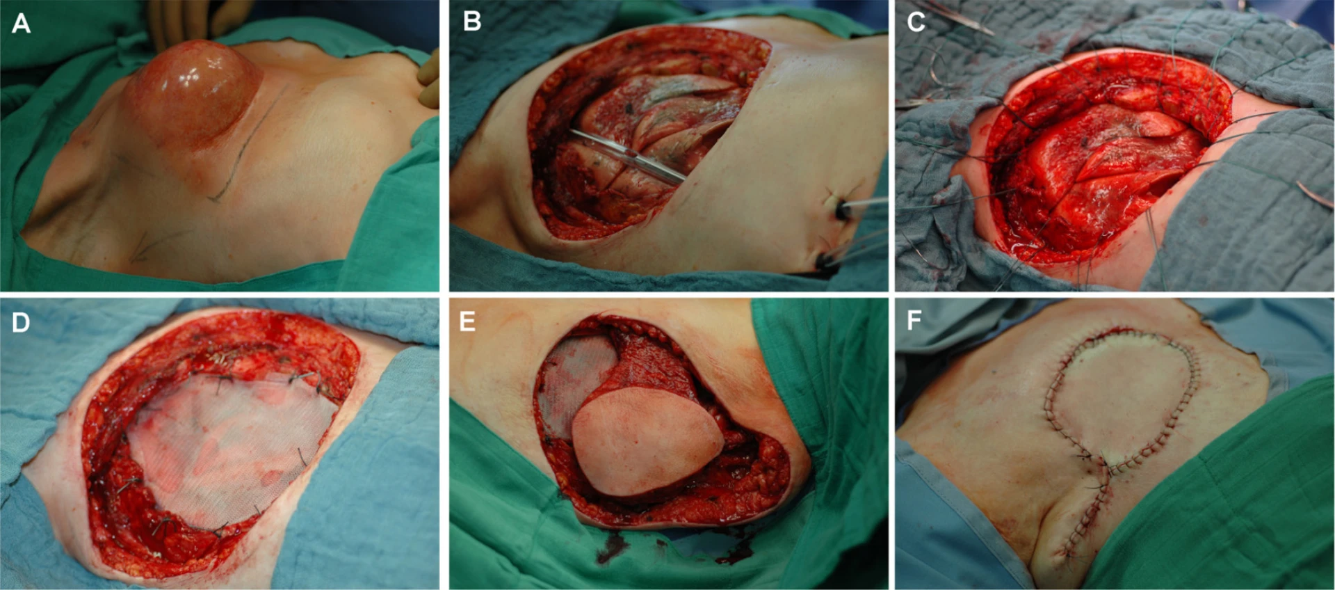 Layered wound closure of a clean surgical wound bed — illustrating the deep dermal + skin layered technique.